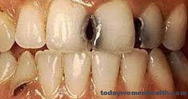 مراحل تسوس الاسنان