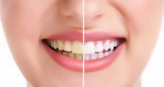 أكثر 10 اسباب تسبب اصفرار الاسنان