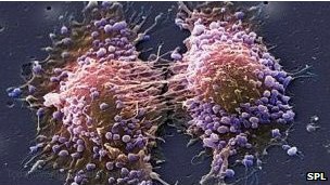 علاج جديد لسرطان البروستاتا بأعراض جانبية اقل