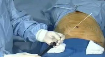 عمليات شفط الدهون لاتضمن الرشاقة للأبد