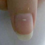 اصفرار الأظافر