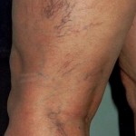 دوالى الساقين خلال الحمل