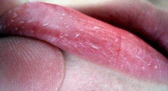 6 نصائح للتخلص من تشققات الشفاة