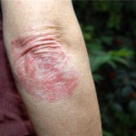 مرض الصدفية 