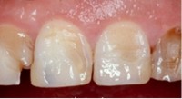 ما أسباب تآكل الأسنان وكيف يمكن منعه؟