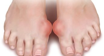 ما هو النقرس وأسباب النقرس وطرق علاج النقرس ؟