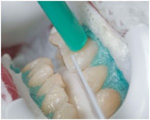 ما الفرق بين طرق تبييض الاسنان ؟