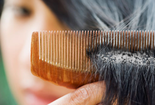 4 حلول سريعة لعلاج قشرة الشعر والقضاء على القشرة نهائيا