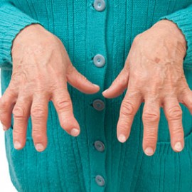 Rheumatoid arthritis of the fingers