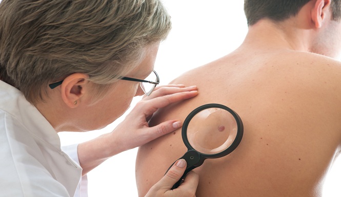 Skin-Cancer-Shutterstock-2