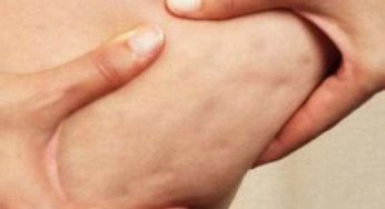السيلوليت اسبابه وطرق الوقاية وعلاج السيلوليت