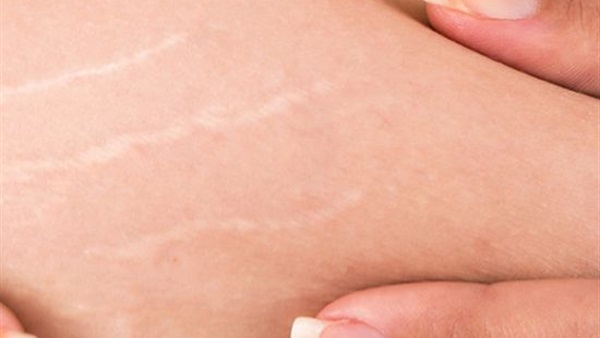 أفضل الطرق للتخلص من علامات التمدد والخطوط البيضاء